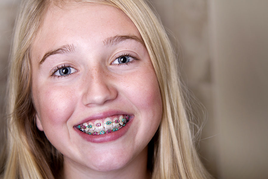 METAL BRACES Orthodontic services by Murray Orthodontics