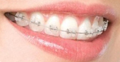 braces_clear
