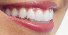 braces_invisible
