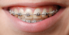 braces_traditional