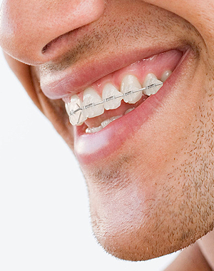 man-with-braces